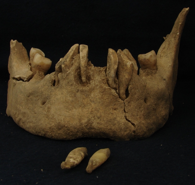 mandible